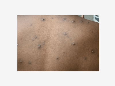 First Case of Monkeypox Virus reported in Alabama